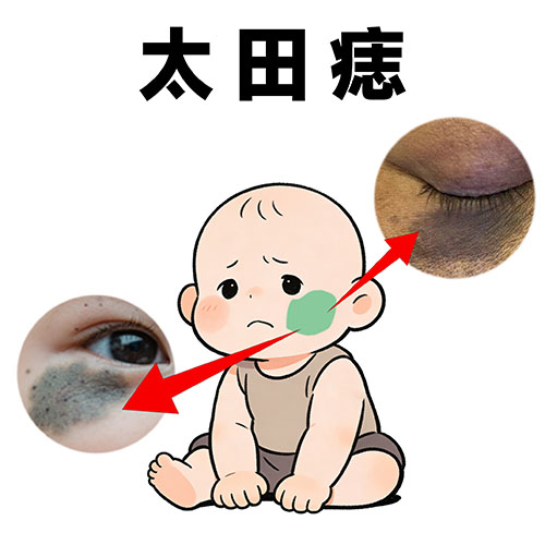 <strong>不同部位的太田痣要做几次激光才好？脸部和背部治疗次数一样吗？</strong>
