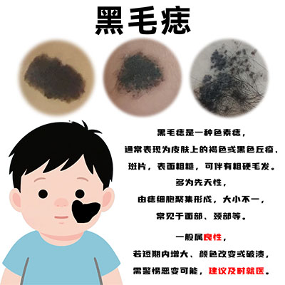 黑毛痣会不会恶变？南京胎记医院排名